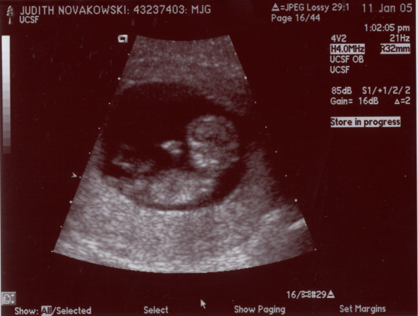 Ultrasound Pictures - Jan. 11, 2005